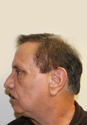 hair transplant photos