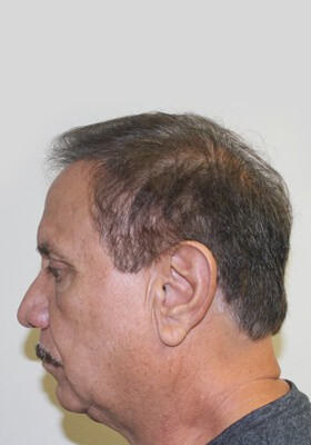 hair transplant photos