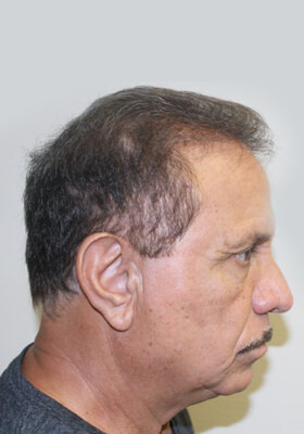 hair transplant photos