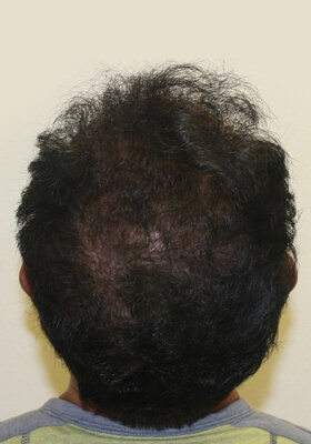 hair transplant photos