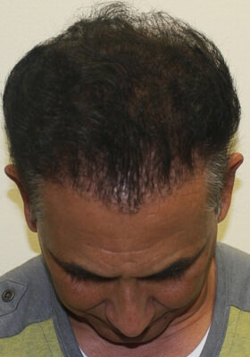 hair transplant before after Photos