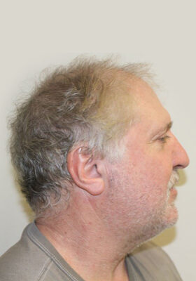 hair transplant before after Photos