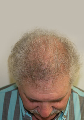 hair transplant photos