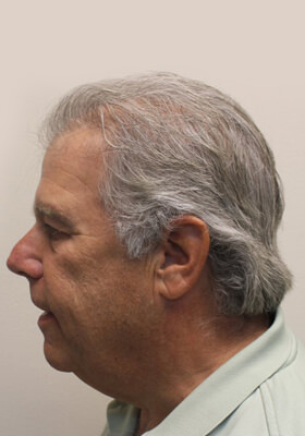 hair transplant photos