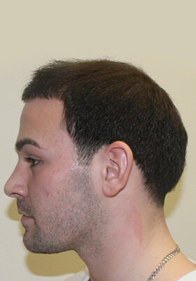 hair transplant photos