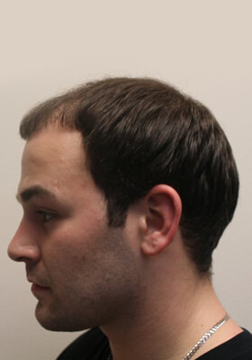 hair transplant photos