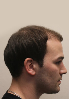 hair transplant before after Photos