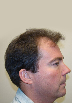 hair transplant before after Photos