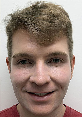 hair transplant before after Photos