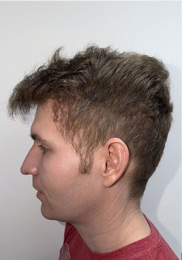 hair transplant before after Photos