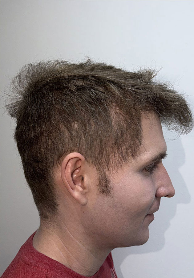 hair transplant photos