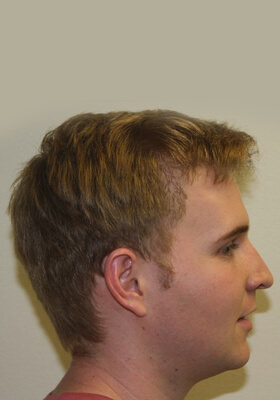 hair transplant photos