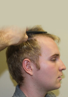 hair transplant photos