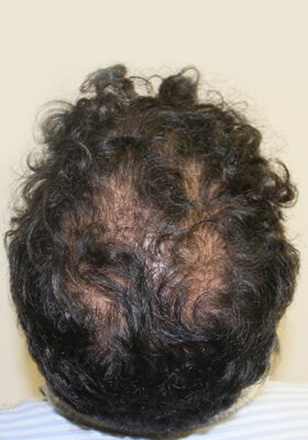 hair transplant photos