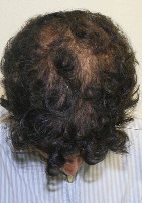 hair transplant photos