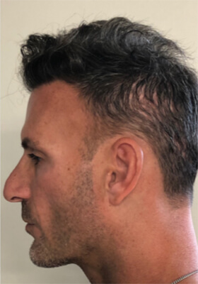 hair transplant photos