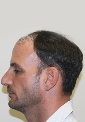 hair transplant photos