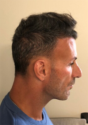 hair transplant photos