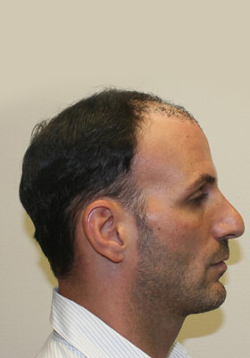 hair transplant photos