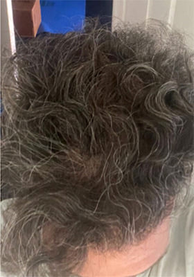 hair transplant photos