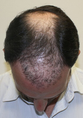 hair transplant photos