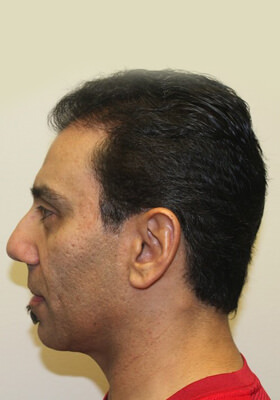 hair transplant photos