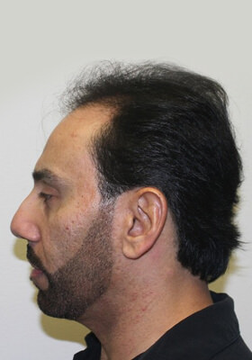 hair transplant photos