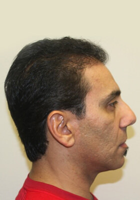 hair transplant photos