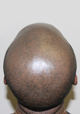 hair transplant photos