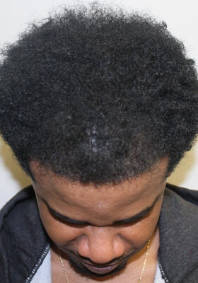 Patients Before After Photos - African American Hair Transplant