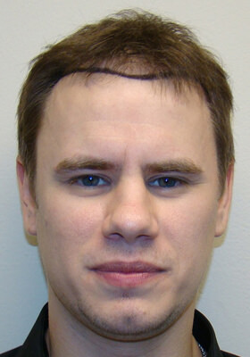 hair transplant photos