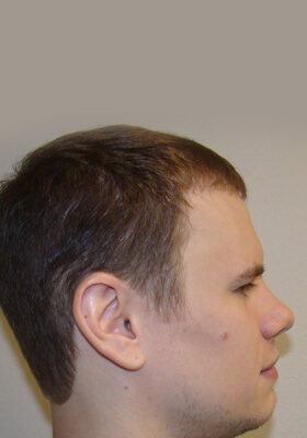 hair transplant photos