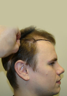 hair transplant photos