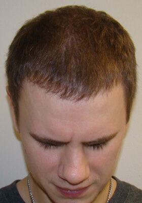 hair transplant before after Photos