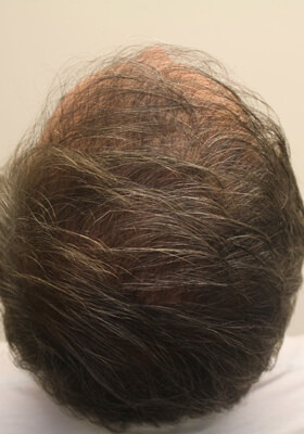 hair transplant photos