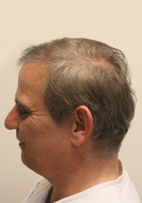 hair transplant before after Photos