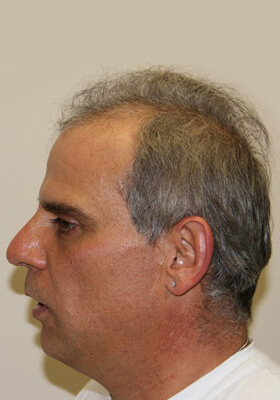 hair transplant before after Photos