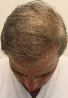 hair transplant before after Photos