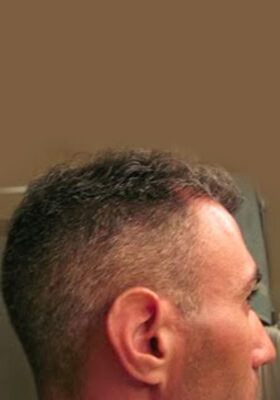 hair transplant photos