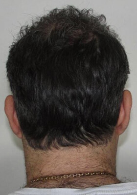 hair transplant photos