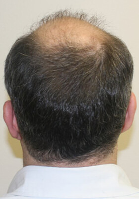 hair transplant photos