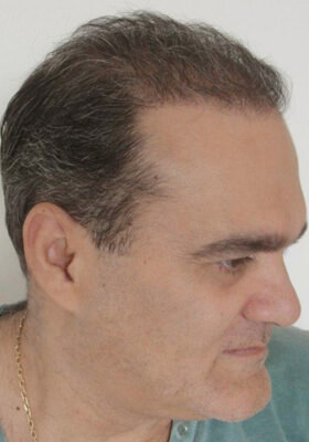 hair transplant photos