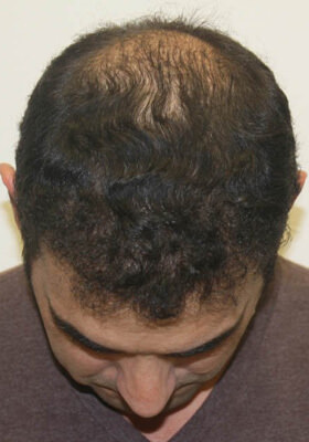 hair transplant photos