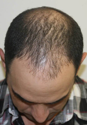 hair transplant photos