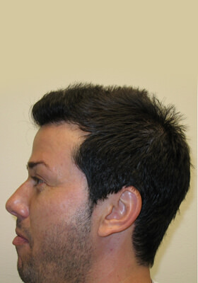 hair transplant photos