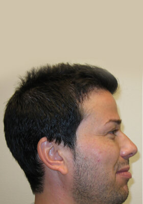 hair transplant photos