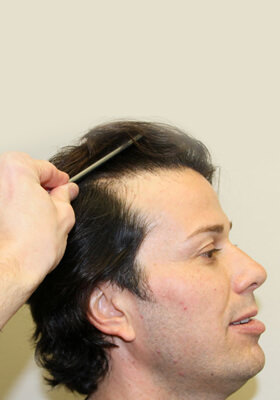 hair transplant photos