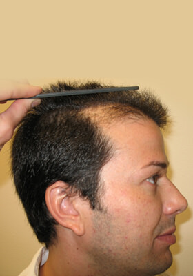 hair transplant photos