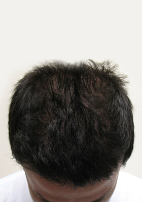 hair transplant photos