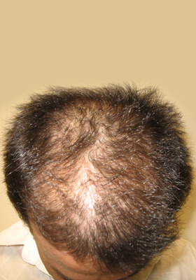 hair transplant photos